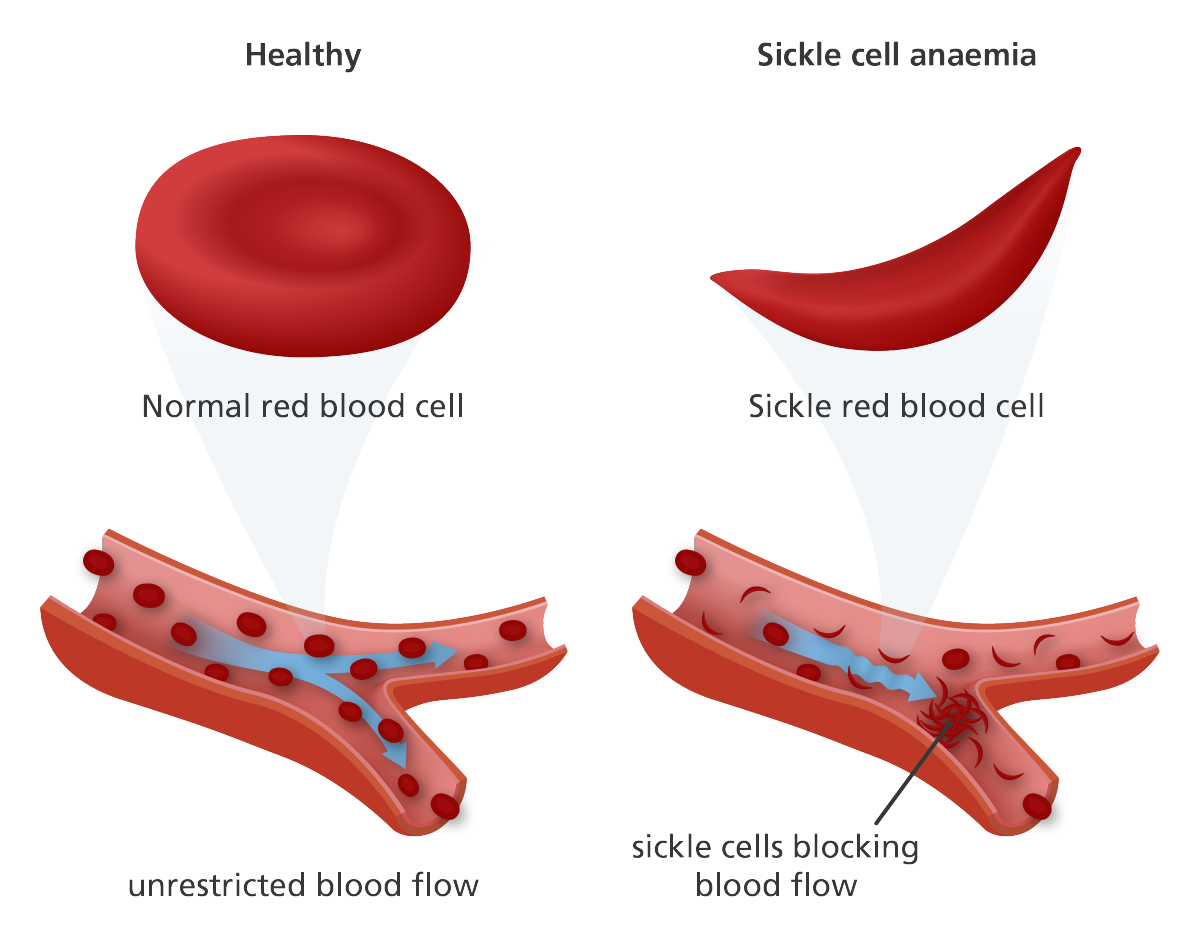 Volunteers Needed for a Sickle Cell Study