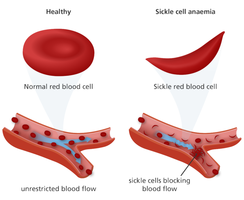 An Introduction to Sickle Cell