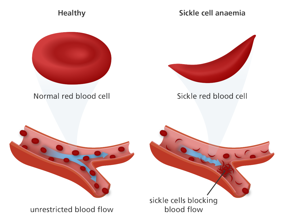 An Introduction to Sickle Cell