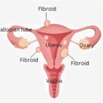 Understanding Fibroids: What Every Woman Should Know